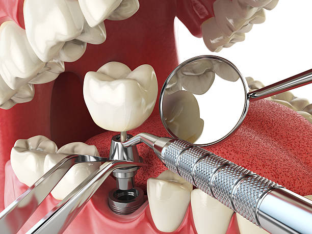 Best Emergency Tooth Extraction in Dodge City, KS